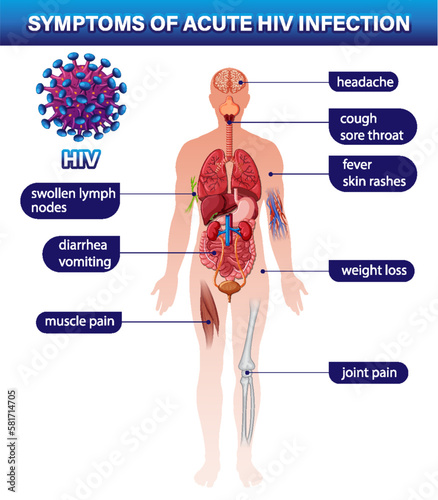 Symptoms of acute HIV infection