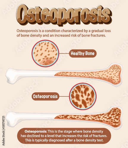 Informative poster of Osteoporosis human bone