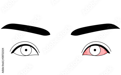 医療イラスト、眼病・結膜炎の線画イラスト