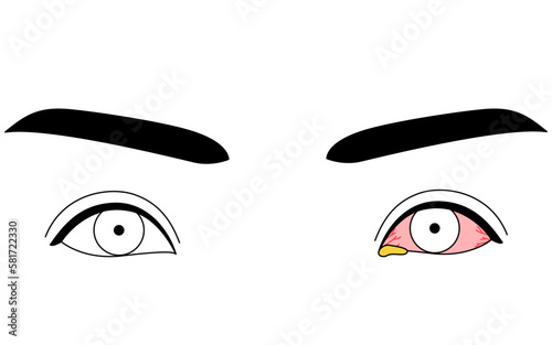 医療イラスト、眼病・細菌性結膜炎の線画イラスト