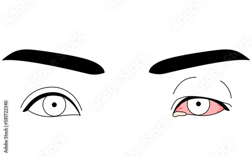 医療イラスト、眼病・ウイルス性結膜炎の線画イラスト