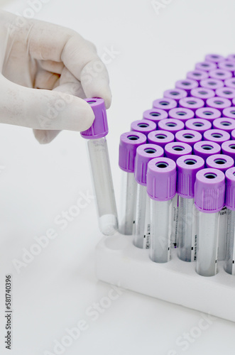 Purple vacuum blood collection tube with EDTA as anticoagulant for Complete blood count test in Medical laboratory.