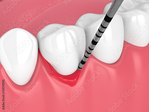 3d render of human jaw with peri implantitis disease and periodontal sonda photo