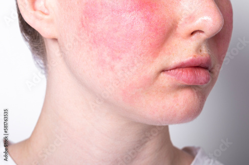rosacea couperose redness skin, red spots on cheeks, young woman with sensitive skin, patient face close-up photo