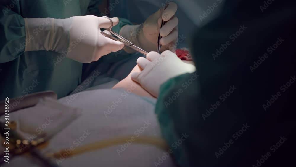 Surgeon Using Forceps Unrecognizable surgeon using surgical forceps and scissors in slow ...