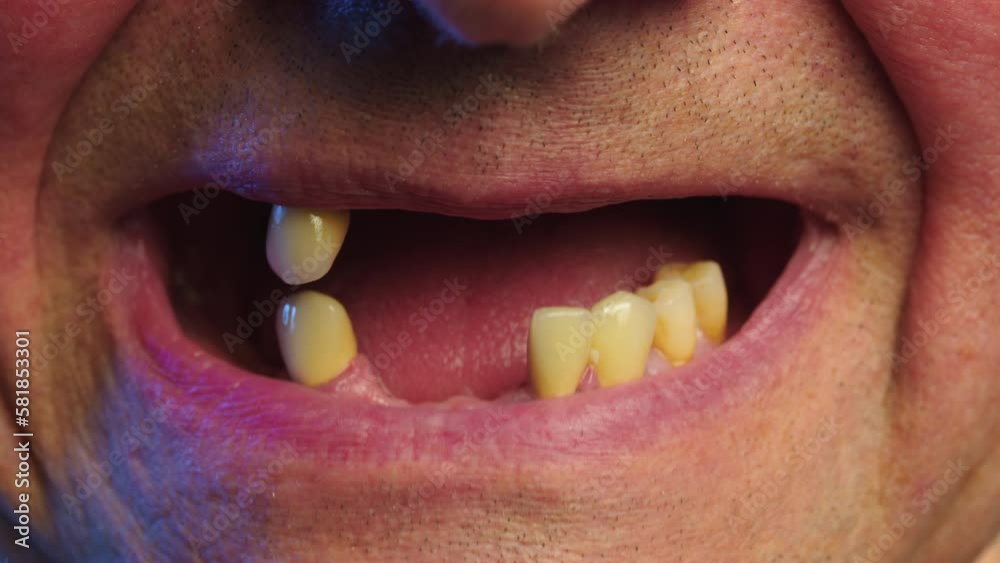 Periodontal disease and missing teeth in an elderly man. Close up shot