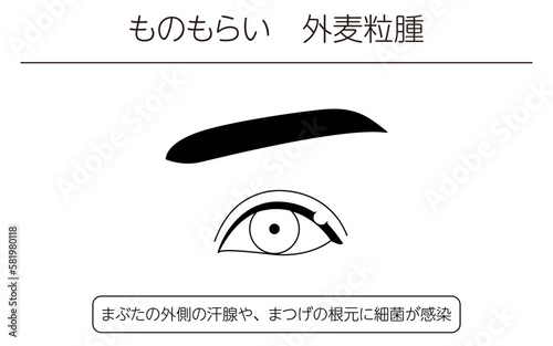 医療イラスト、眼病・ものもらい（外麦粒腫）の線画イラスト