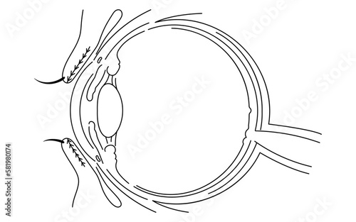 医療イラスト、眼病・ものもらいの発生部についての解剖図