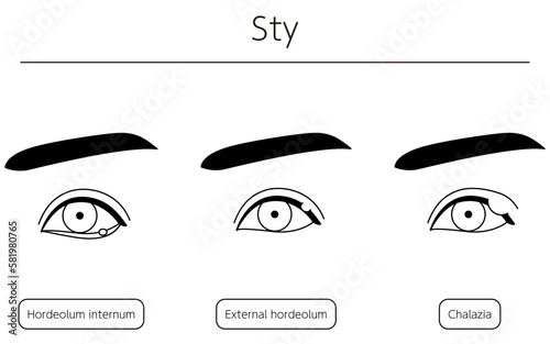 Medical Clipart, Line Drawing Illustration of Eye Disease and Sty, chalazia photo