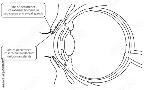 Medical illustration, Anatomical drawing of the site of origin of eye disease and mononucleosis