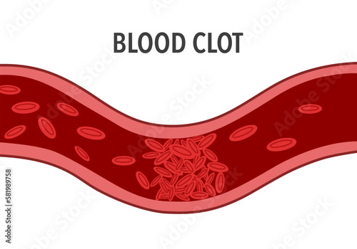 Blood clot in vein flat design on white background.