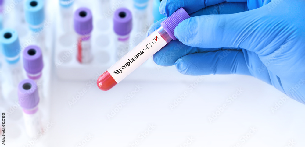 Naklejka premium Doctor holding a test blood sample tube positive with Mycoplasma test on the background of medical test tubes with analyzes.Banner.