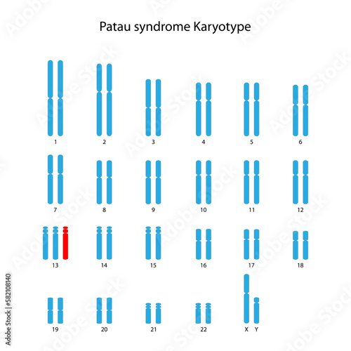 Patau syndrome (trisomy 13) human (male) karyotype