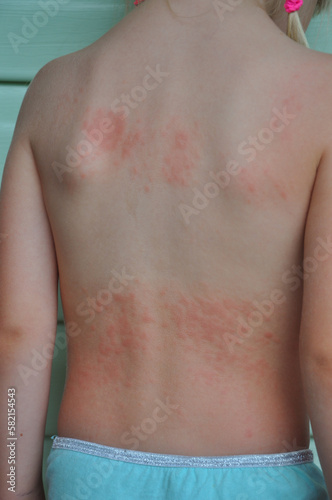Back of a child with urticaria. Allergy. Eruptions on the back.