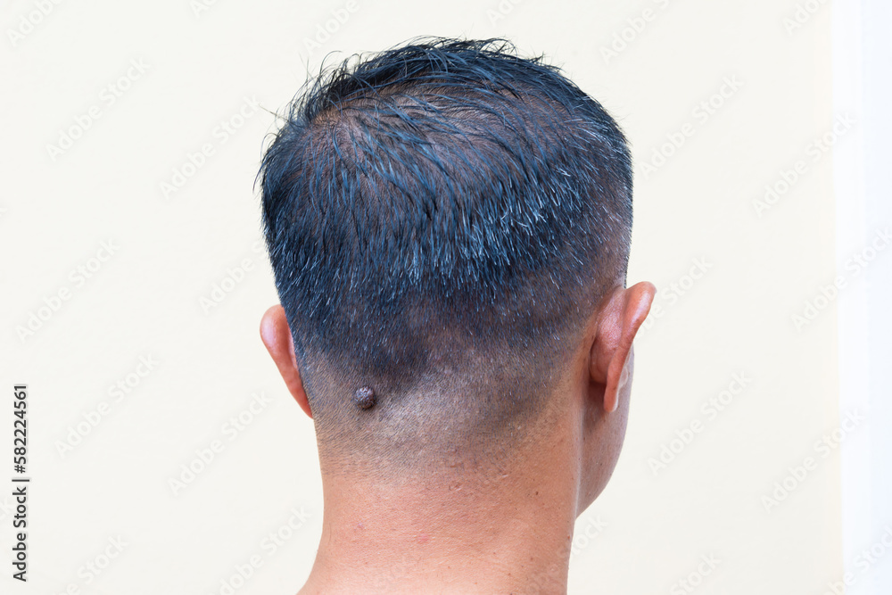 A large mole on the man's head.wart nodules.
A large mole on the man's head.wart nodules.
