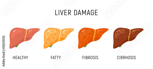 Liver damage infographic diagram cancer disease anatomy. Liver damage organ tissue hepatic carcinoma fibrosis stages. photo