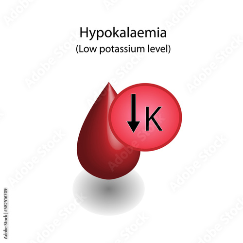 Hypokalaemia, low plasma potassium level. Potassium K excess and deficit electrolyte disorders, blood test tube, Scientific design. Vector illustration.