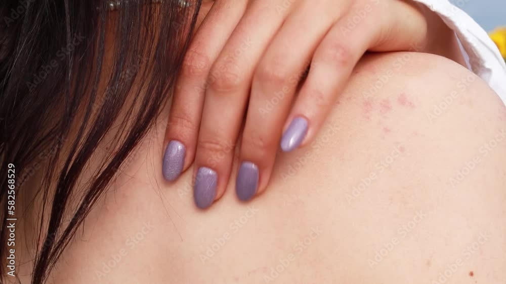 Woman standing outside street scratching redness from insect bite, itching shoulder arm mosquito bite in summer. Wound red spot after tick mite on skin, bee sting. Dermatology, allergy reaction
Woman standing outside street scratching redness from insect bite, itching shoulder arm mosquito bite in summer. Wound red spot after tick mite on skin, bee sting. Dermatology, allergy reaction