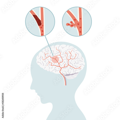 Ischemic stroke and hemorrhagic stroke, stroke brain concept in flat vector.