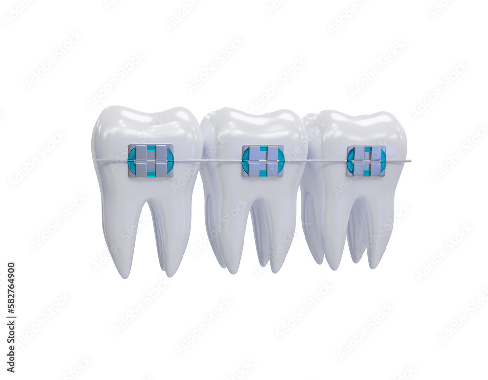 Teeth metal braces. Teeth alignment. Three white teeth with braces on a ...