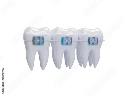 Teeth metal braces. Teeth alignment. Three white teeth with braces on a transparent background. PNG. 3d render