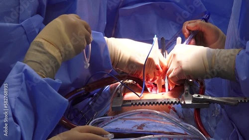 A team of surgeons in a hospital open heart surgery in the operating room. A beating human heart in an open-chest surgical chest during heart surgery.