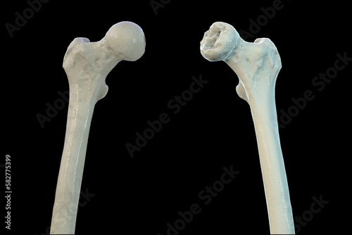 Femur bone affected by Legg-Calve-Perthes Disease, a childhood hip disorder, 3D illustration photo