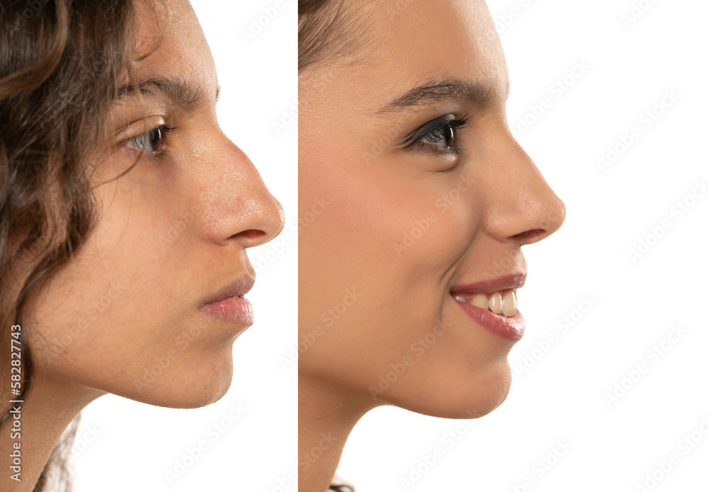 Woman Rhinoplasty. Women Nose Shape Before and After Plastic Surgery. Woman Profile Side View over isolated White Background Woman Rhinoplasty. Women Nose Shape Before and After Plastic Surgery. Woman Profile Side View over isolated White Background