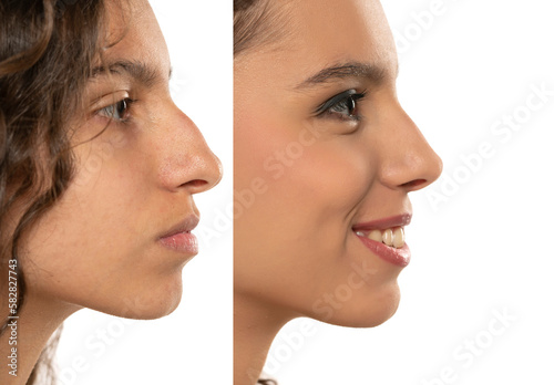 Woman Rhinoplasty. Women Nose Shape Before and After Plastic Surgery. Woman Profile Side View over isolated White Background
