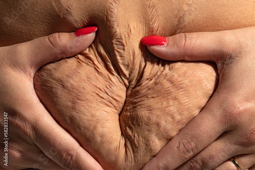 Woman displaying loose skin and stretch marks after pregnancy