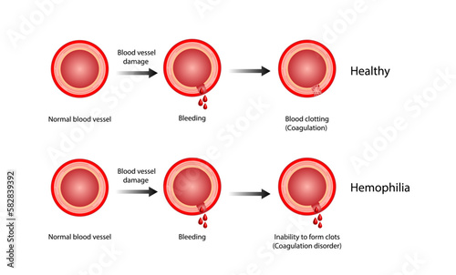 Hemophilia, a bleeding disorder that slows the blood clotting. Haemophilia (Coagulation disorder). Damaged blood vessel, hemorrhage. Healthy blood vessel after bleeding. Vector illustration.