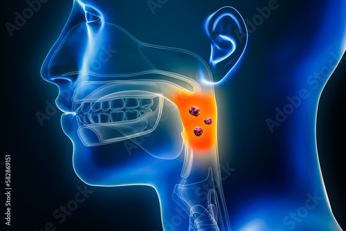 Oropharynx or throat cancer with organs and tumors or cancerous cells 3D rendering illustration. Anatomy, oncology, pharynx disease, medical, biology, science, healthcare concepts.