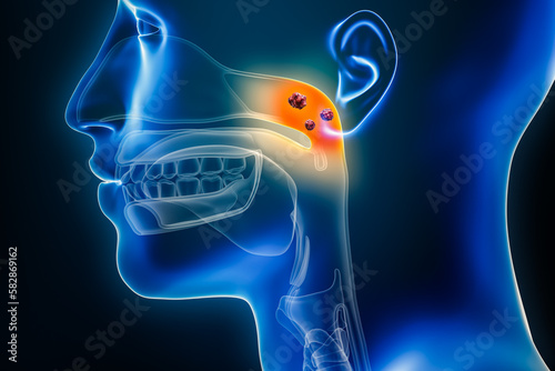 Nasopharynx cancer with organs and tumors or cancerous cells 3D rendering illustration. Anatomy, oncology, pharynx disease, medical, biology, science, healthcare concepts. photo