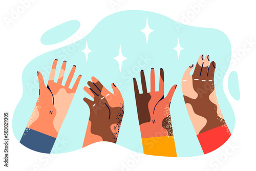 Hands of people with different skin colors affected by vitiligo disease after pigmentation disorders