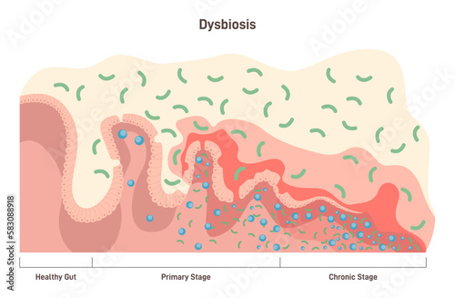 Dysbiosis or dysbacteriosis stages. Intestine disease, imbalance photo