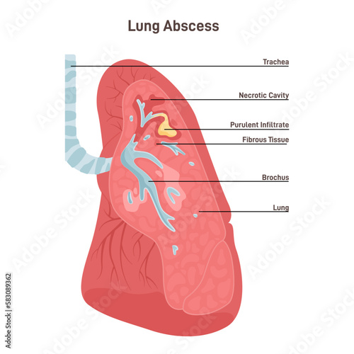 Lung abscess. Microbial infection of the lung causing necrosis of the pulmonary