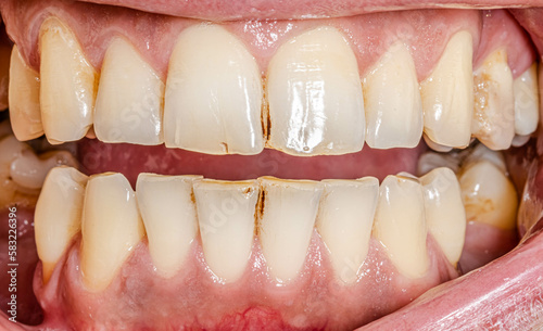 Front view of separate dental arches, lips and cheeks retracted. Unhealthy teeth with barely visible micro cracks and a blackish brown color in proximal areas extrinsic staining like black stain.