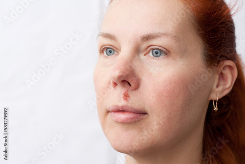 Herpes above upper lip in woman. Portrait middle aged woman with problem skin, on light background. Infectious inflammation of face and lips caused by herpes simplex virus. Dermatology. Medicine.
