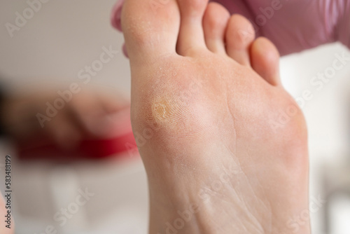 Close-up of calluses on the foot. Painful callus on the leg photo