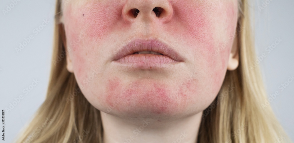 Rosacea face. The girl suffers from redness on her cheeks. Couperosis ...