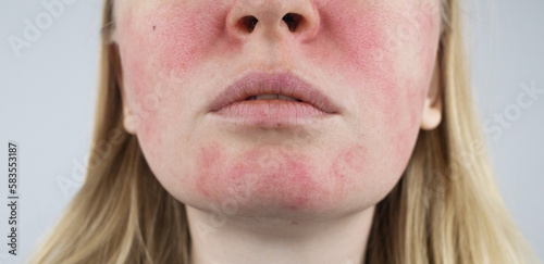 Rosacea face. The girl suffers from redness on her cheeks. Couperosis of the skin. Redness and capillary mesh are visible on the face. Treatment and removal. Vascular surgery and dermatology