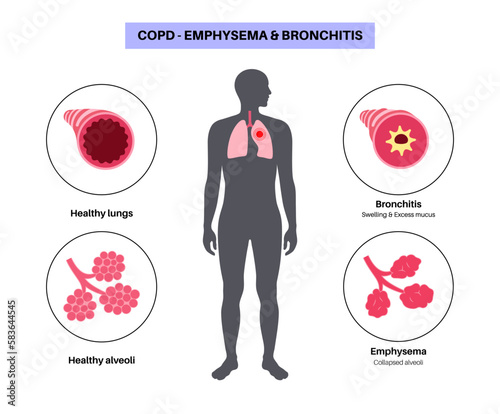 Chronic obstructive pulmonary disease