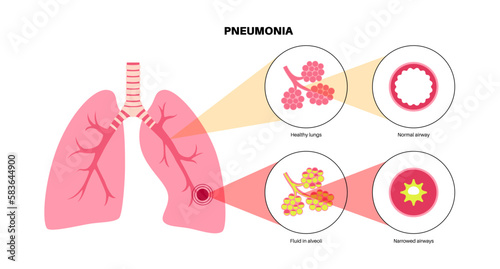 Pneumonia infection poster
