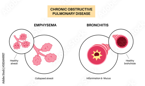 Chronic obstructive pulmonary disease