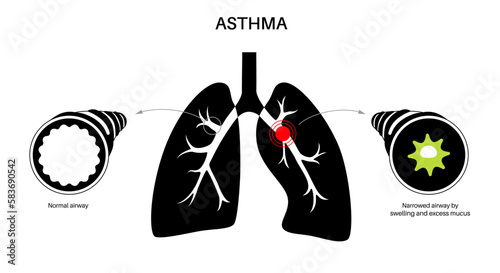 Asthma lung disease