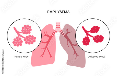 Emphysema anatomical poster