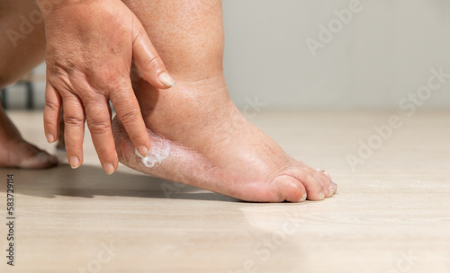 Woman apply moisture lotion on edema (swelling) leg after cancer treatment. Broken heel. © toa555