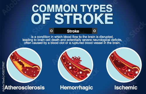 Informative poster of common types of stoke