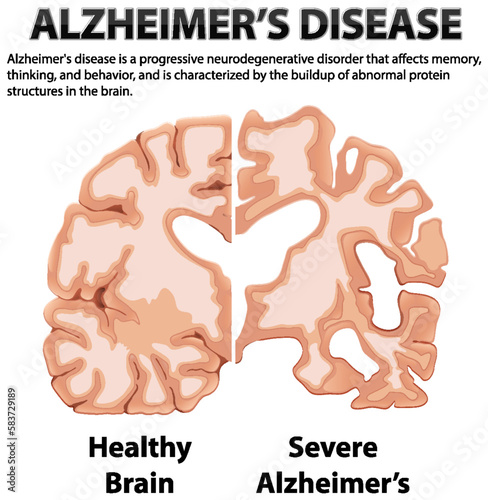 Informative poster of Alzheimers disease