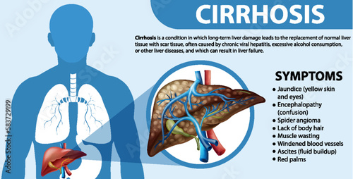 Informative poster of alcoholic liver disease Cirrhosis